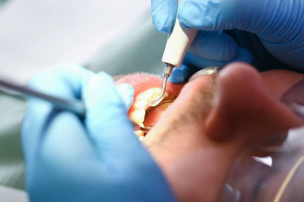 Best Emergency Wisdom Tooth Extraction in Inwood, WV
